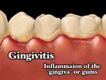 Gingivitis-And-Your-Teeth