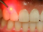 Laser-Periodontal-Therapy