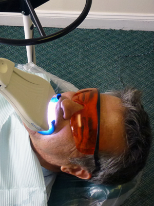 teeth-whitening-stephen-wolpo-dds-smile-sensations--implants-invisalign-gum-disease-stamford-ct