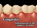 gingivitis-and-your-teeth