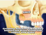 sinus-augmentation