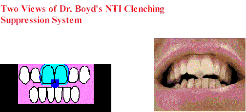 bruxism-boyds-clenching-suppression-system-001