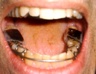 bruxism-cure-taste-based-approach